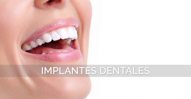 Implantes-Dentales-Valencia-1030×539