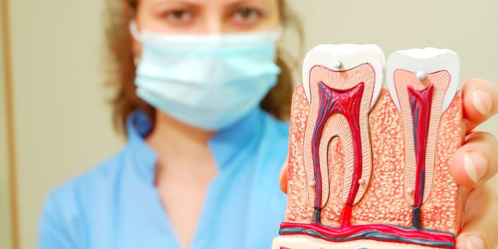 ¿Cuándo es necesario el tratamiento del nervio dental? – Clínica Susana