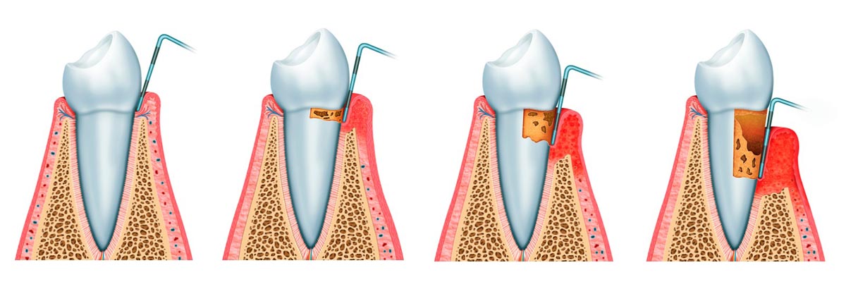 Periodoncia en Gandia